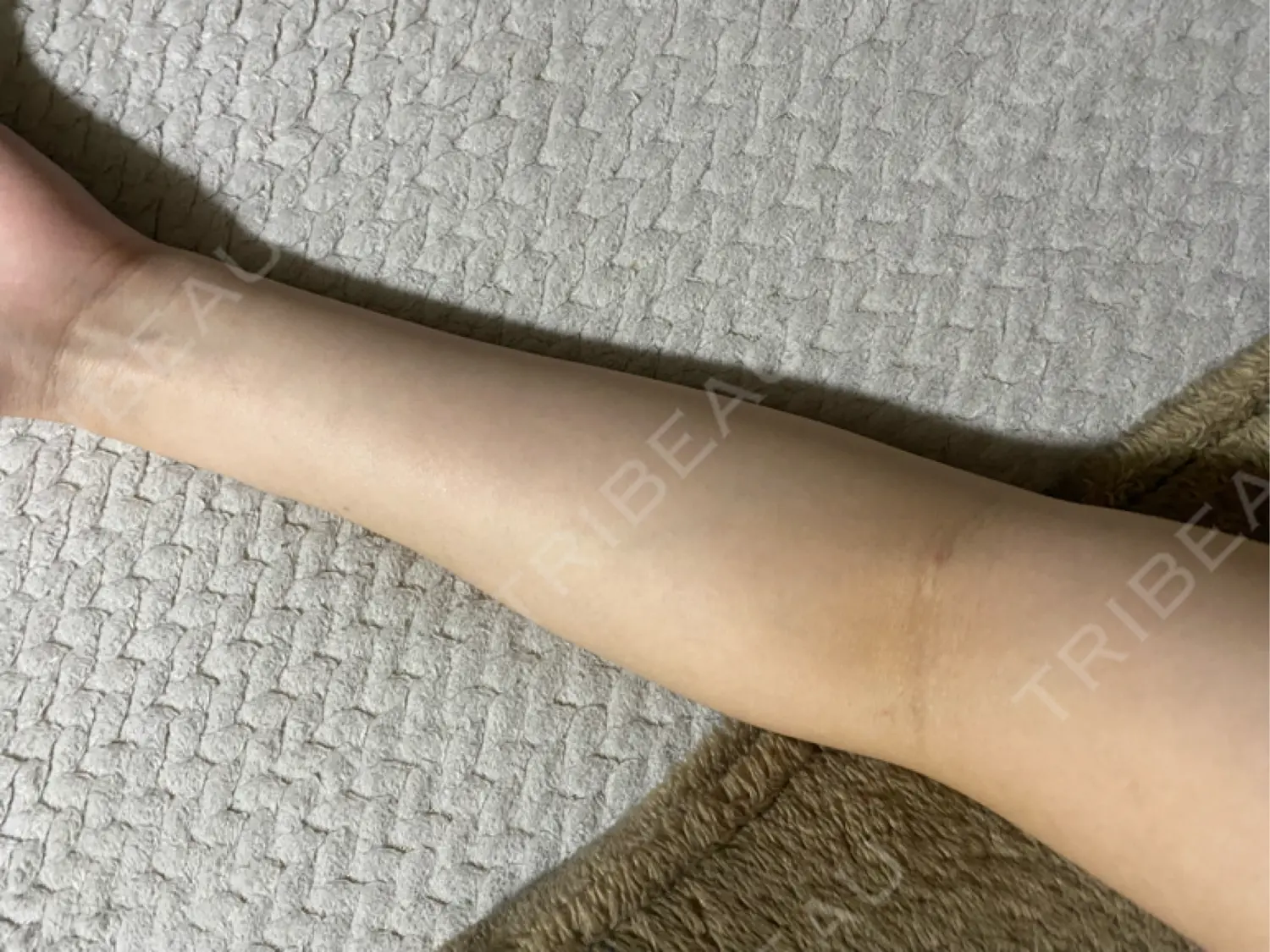 施術前の写真