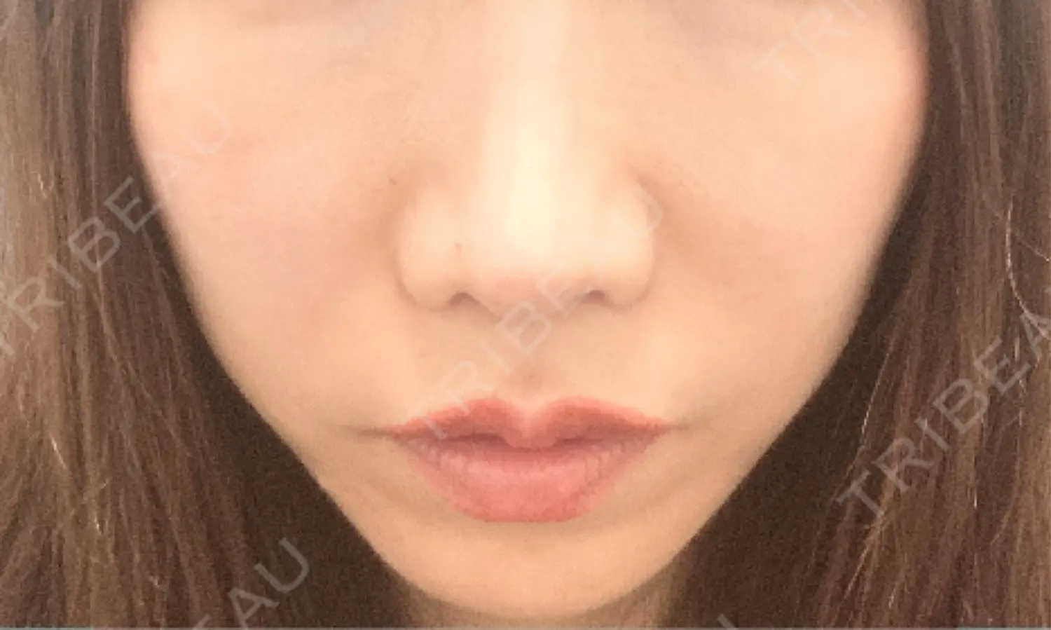 施術前の写真