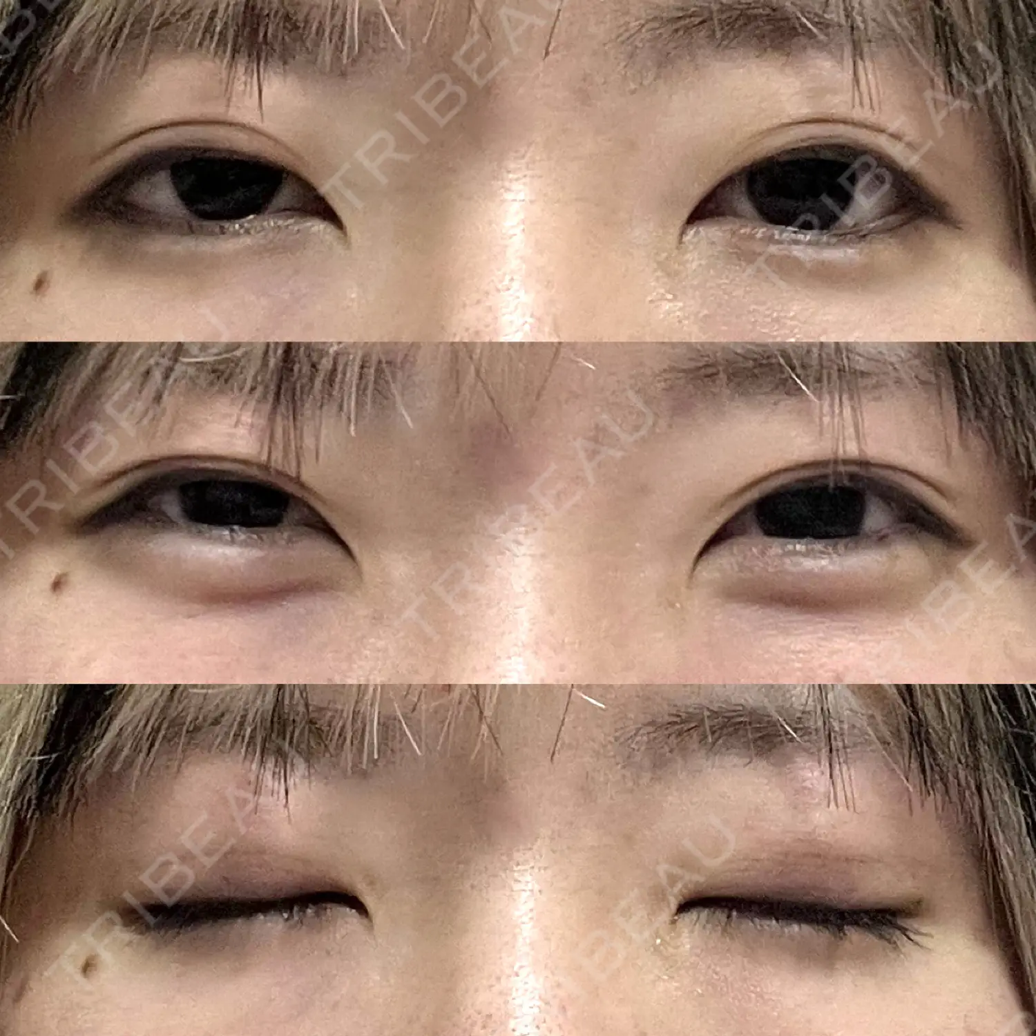 施術前の写真