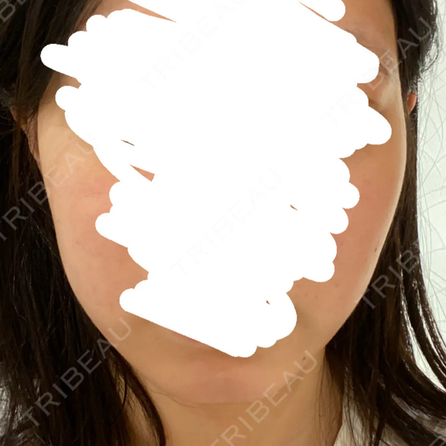施術前の写真