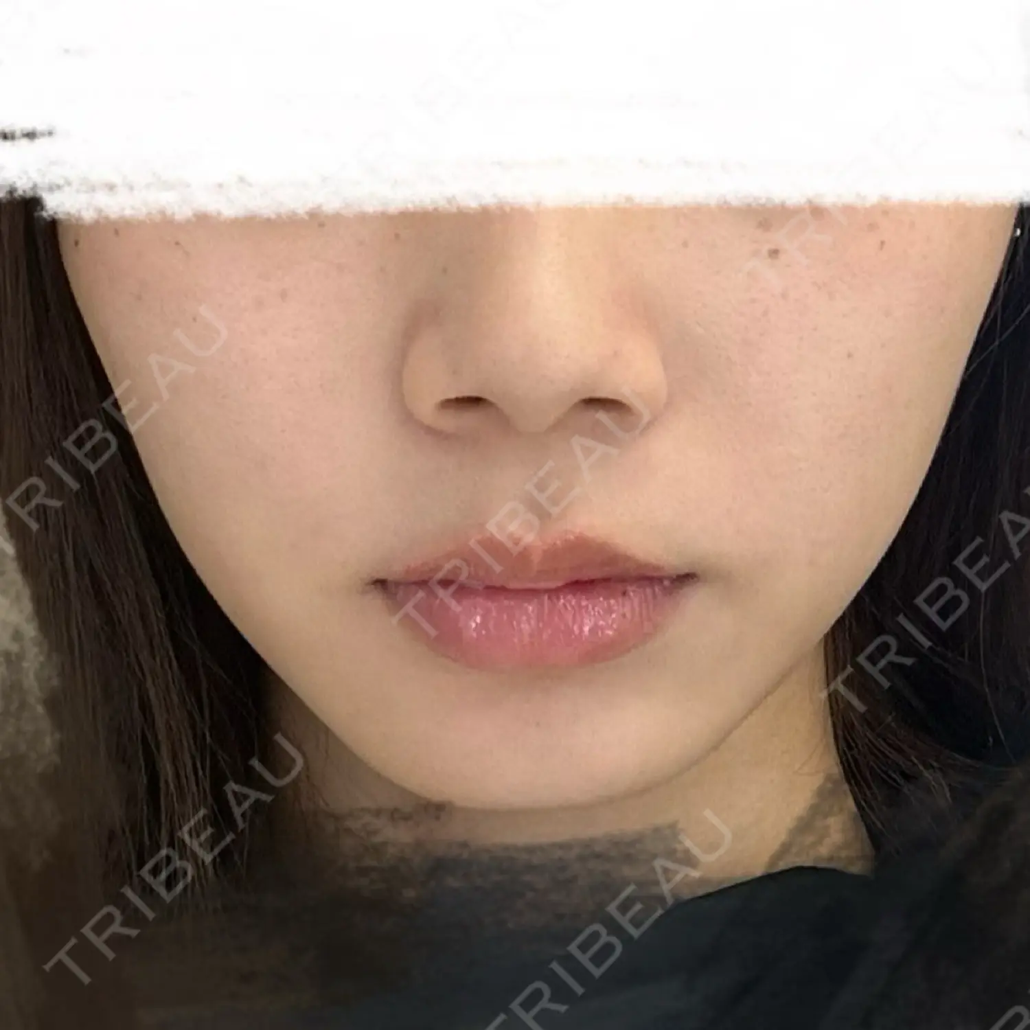 施術前の写真