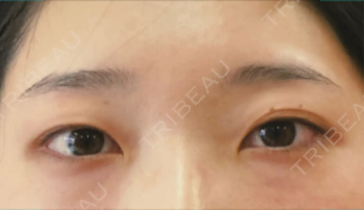施術前の写真