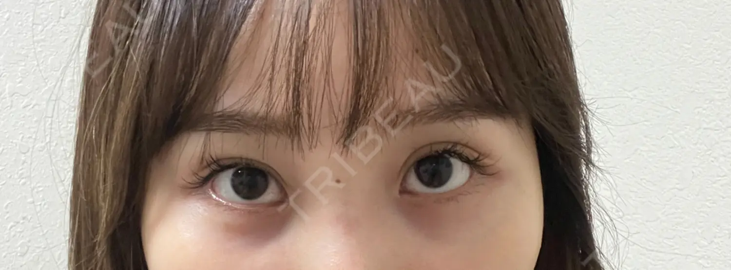 施術前の写真