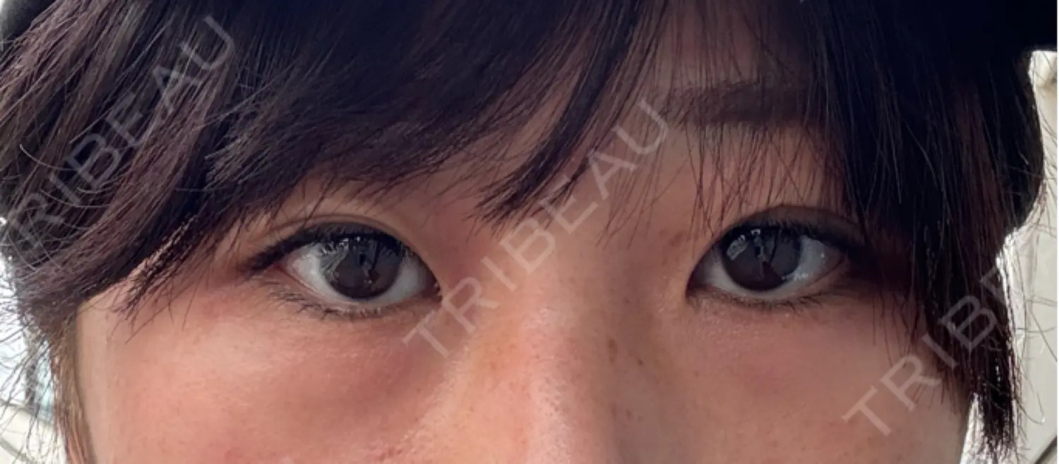 施術前の写真