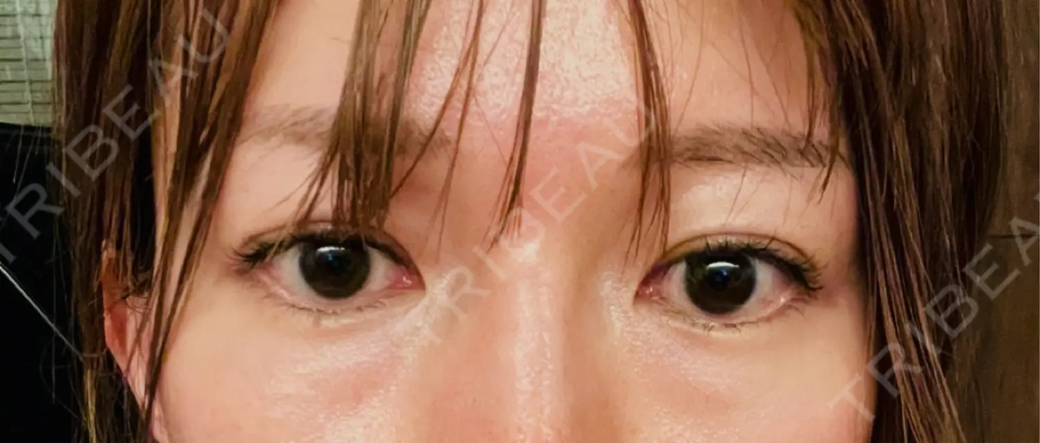 施術前の写真