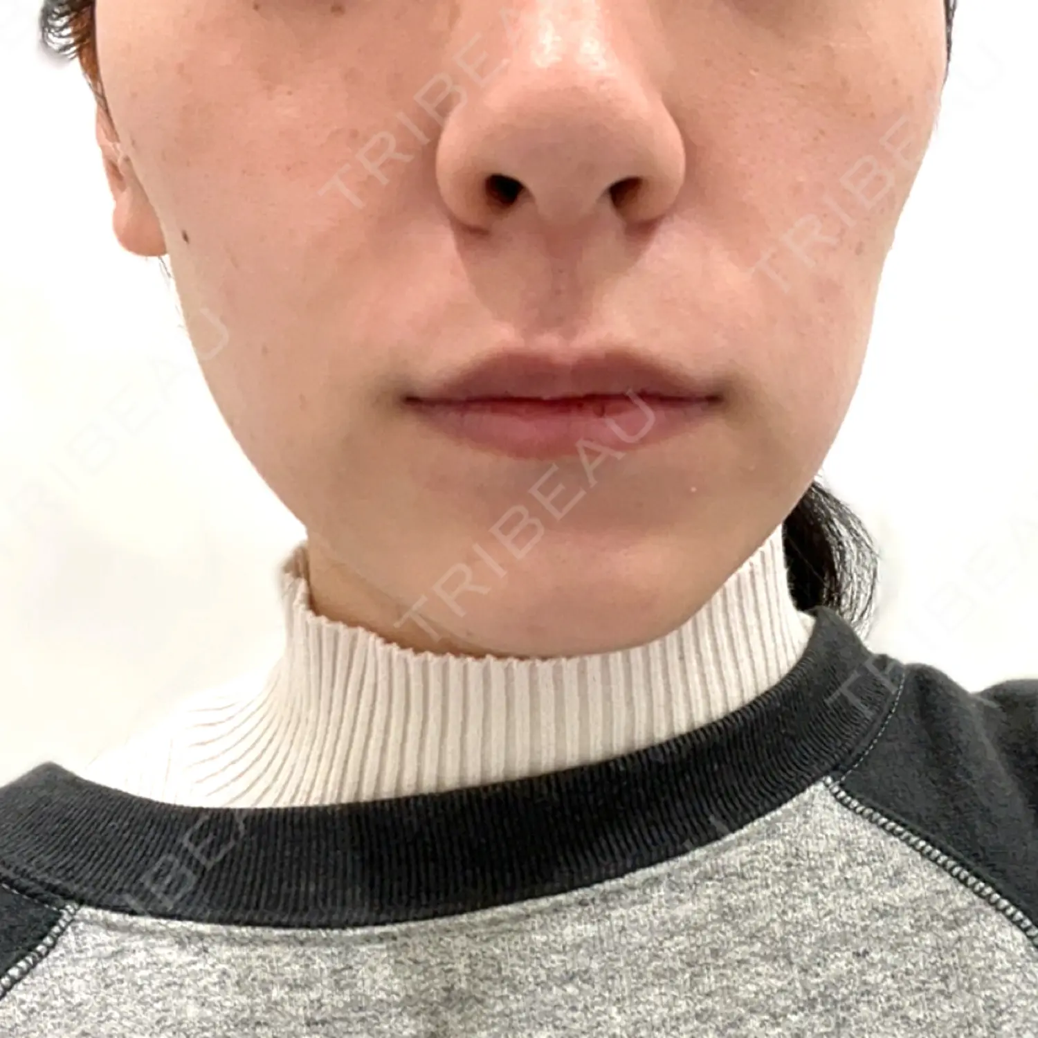 施術前の写真