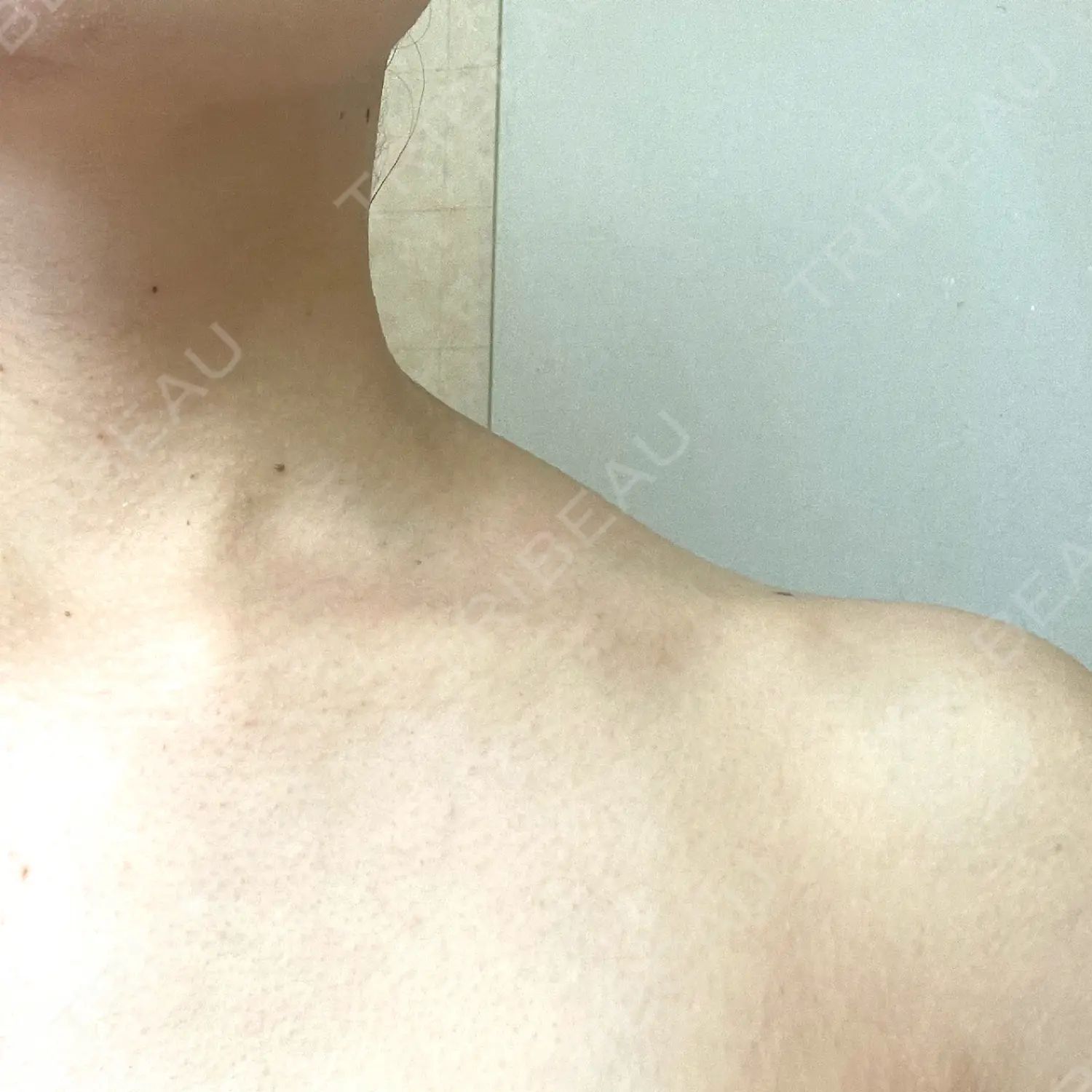 施術前の写真