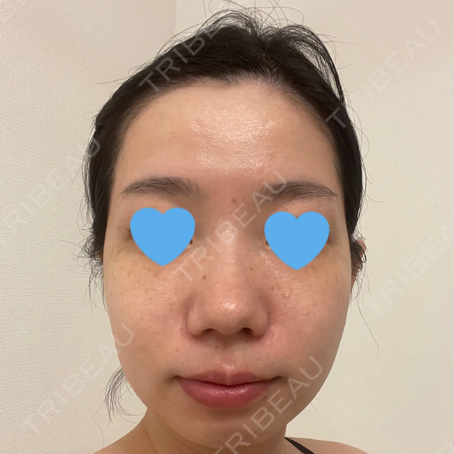 施術前の写真
