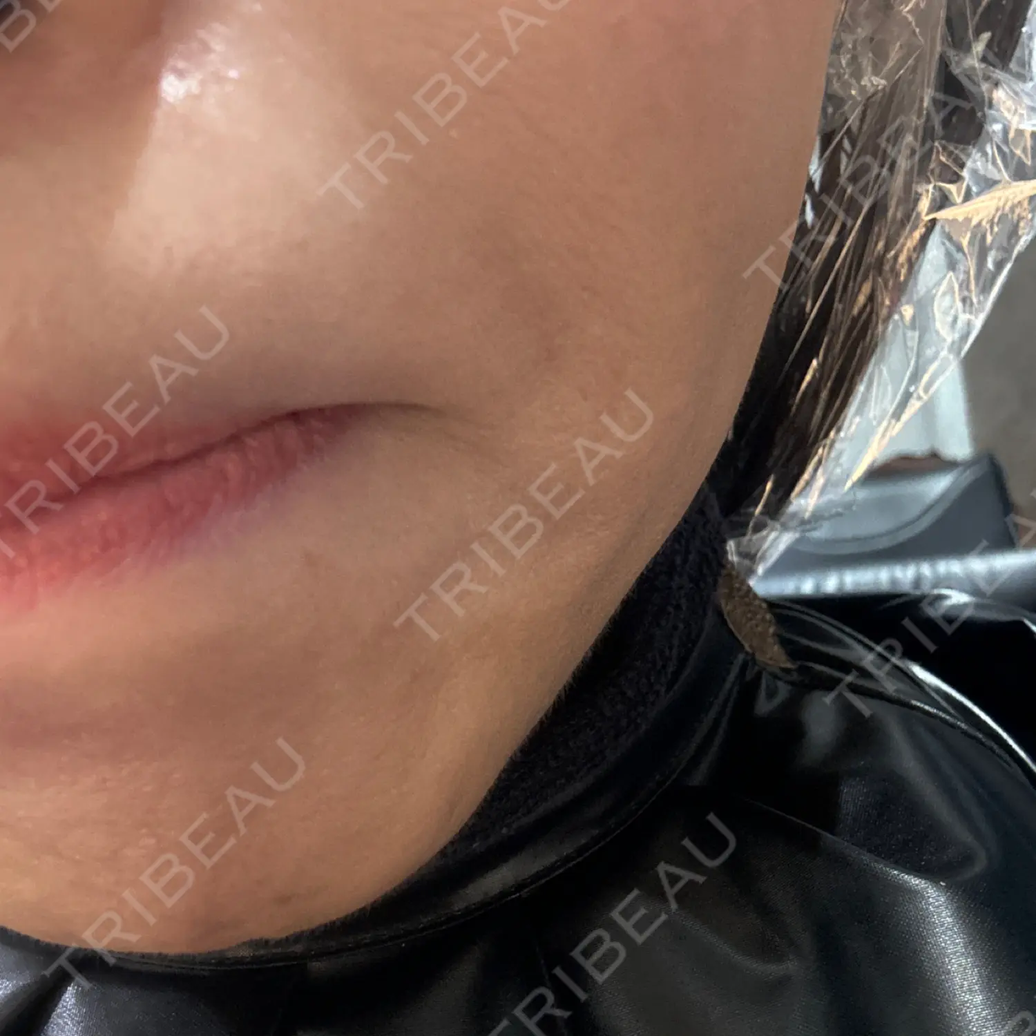 施術前の写真