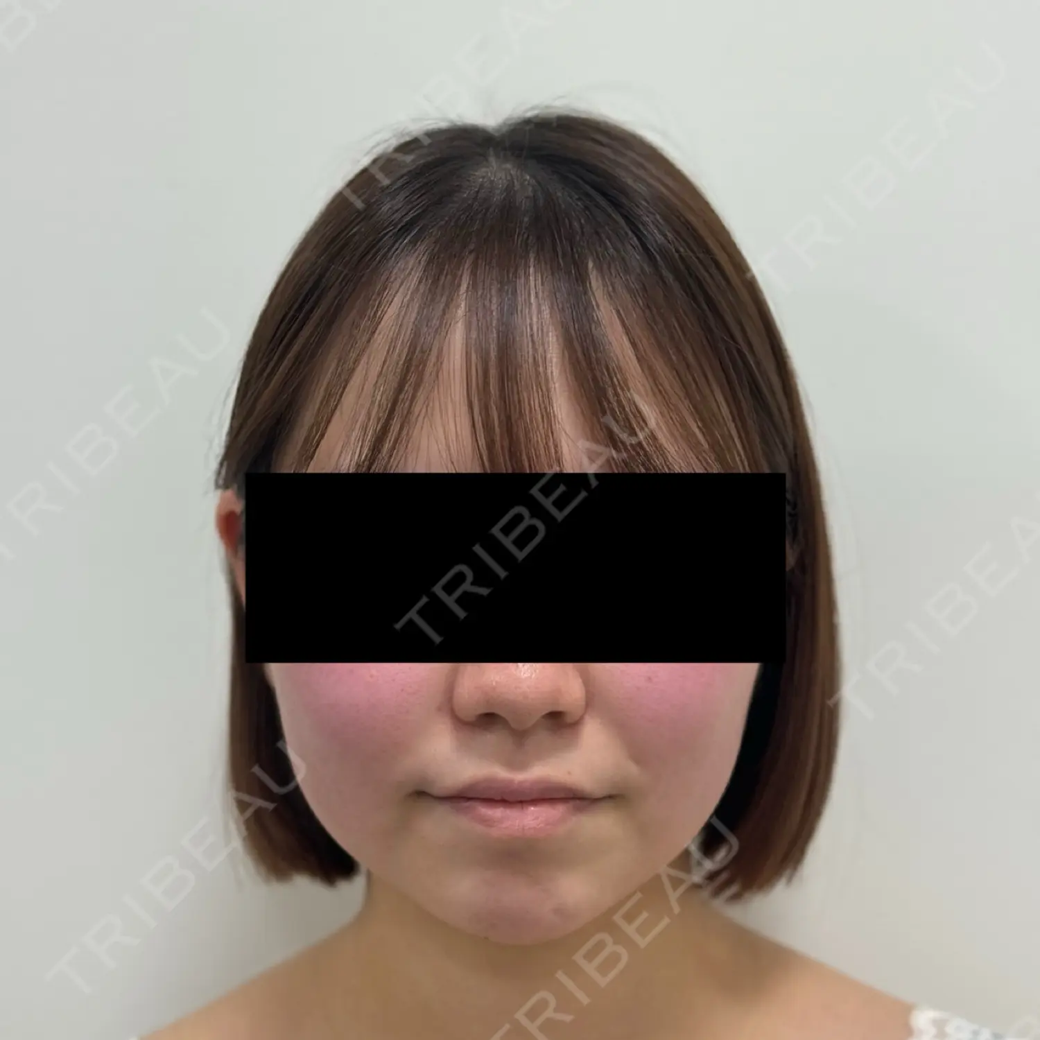 施術前の写真