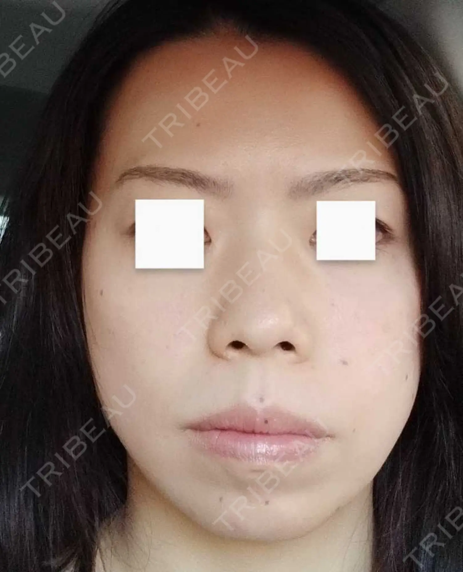 施術前の写真