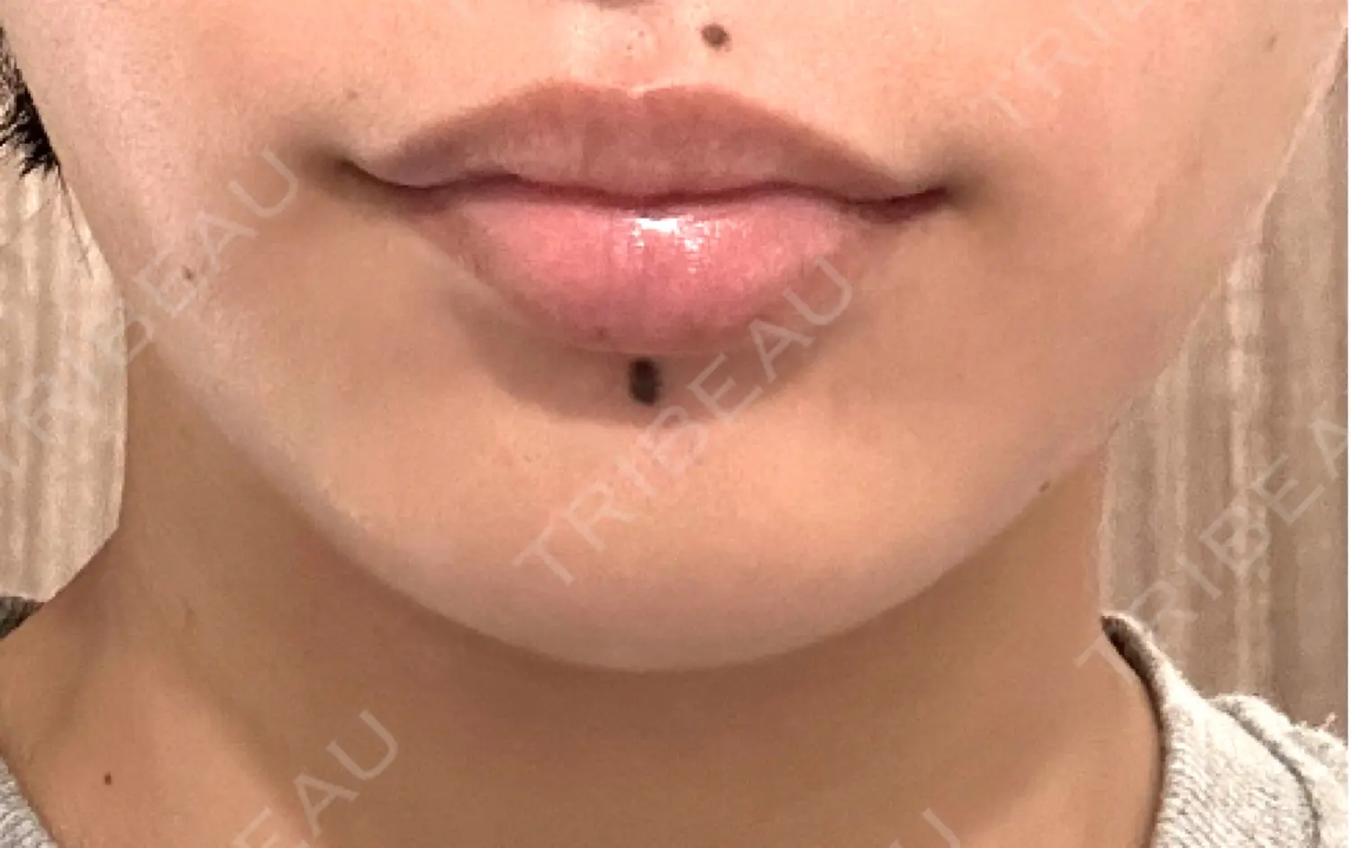 施術前の写真