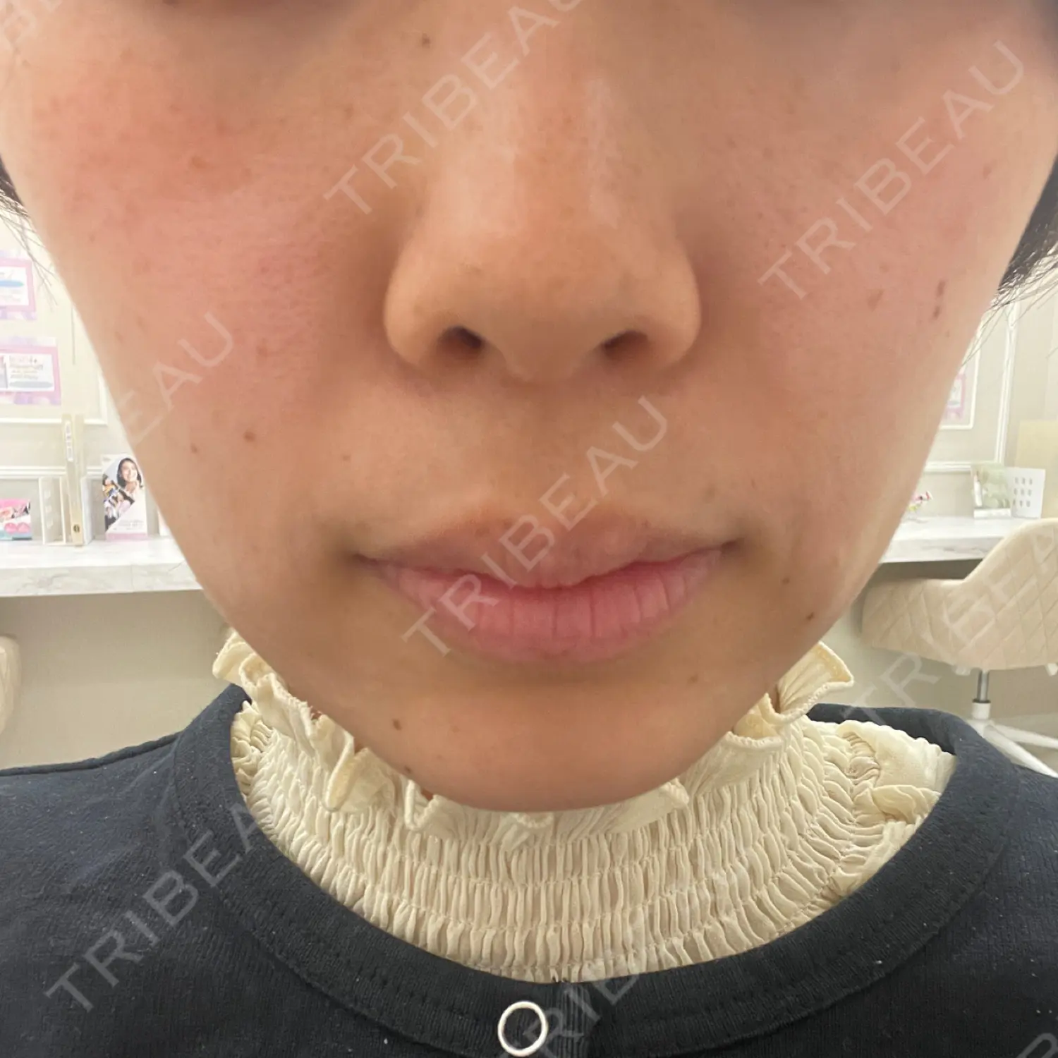 施術前の写真