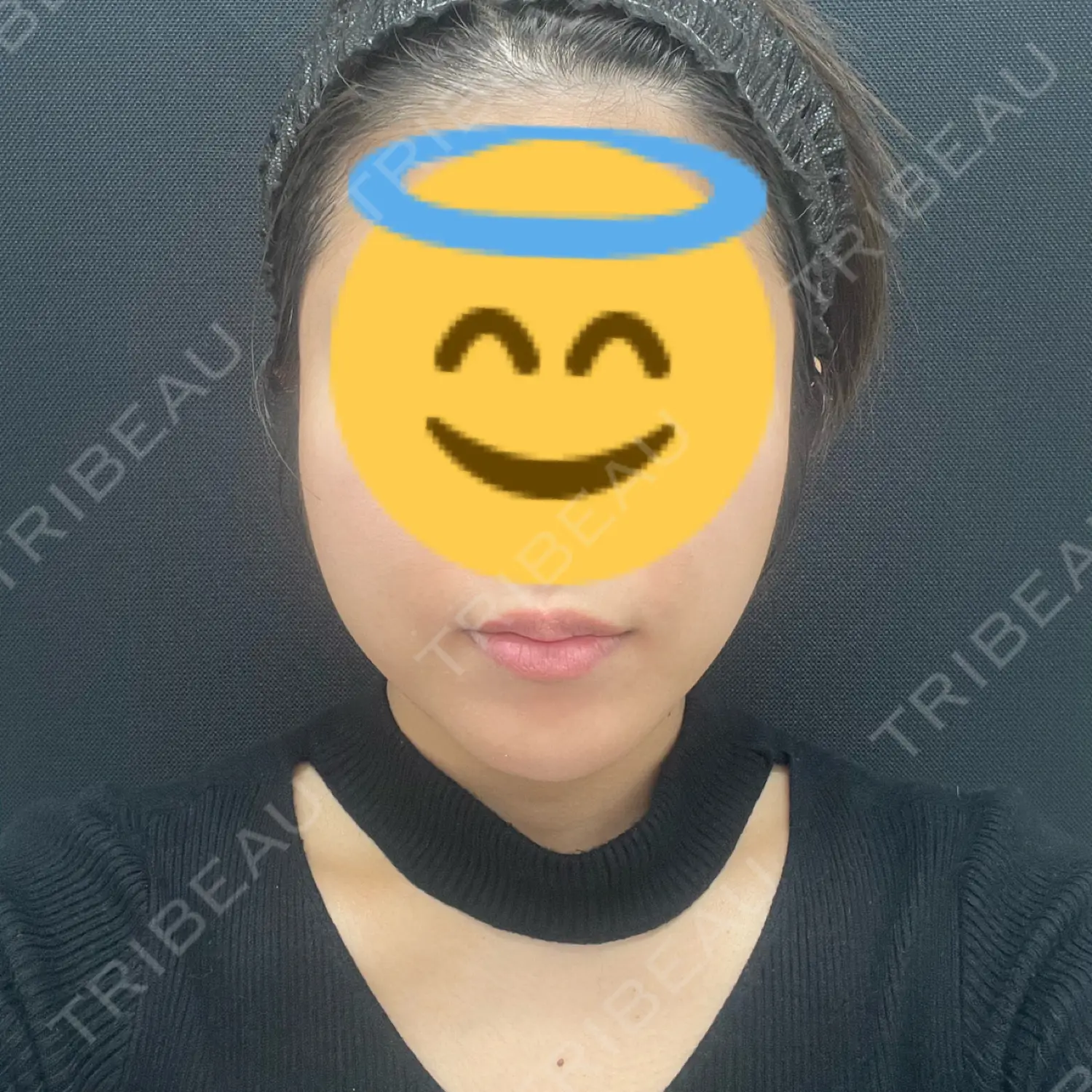 施術前の写真