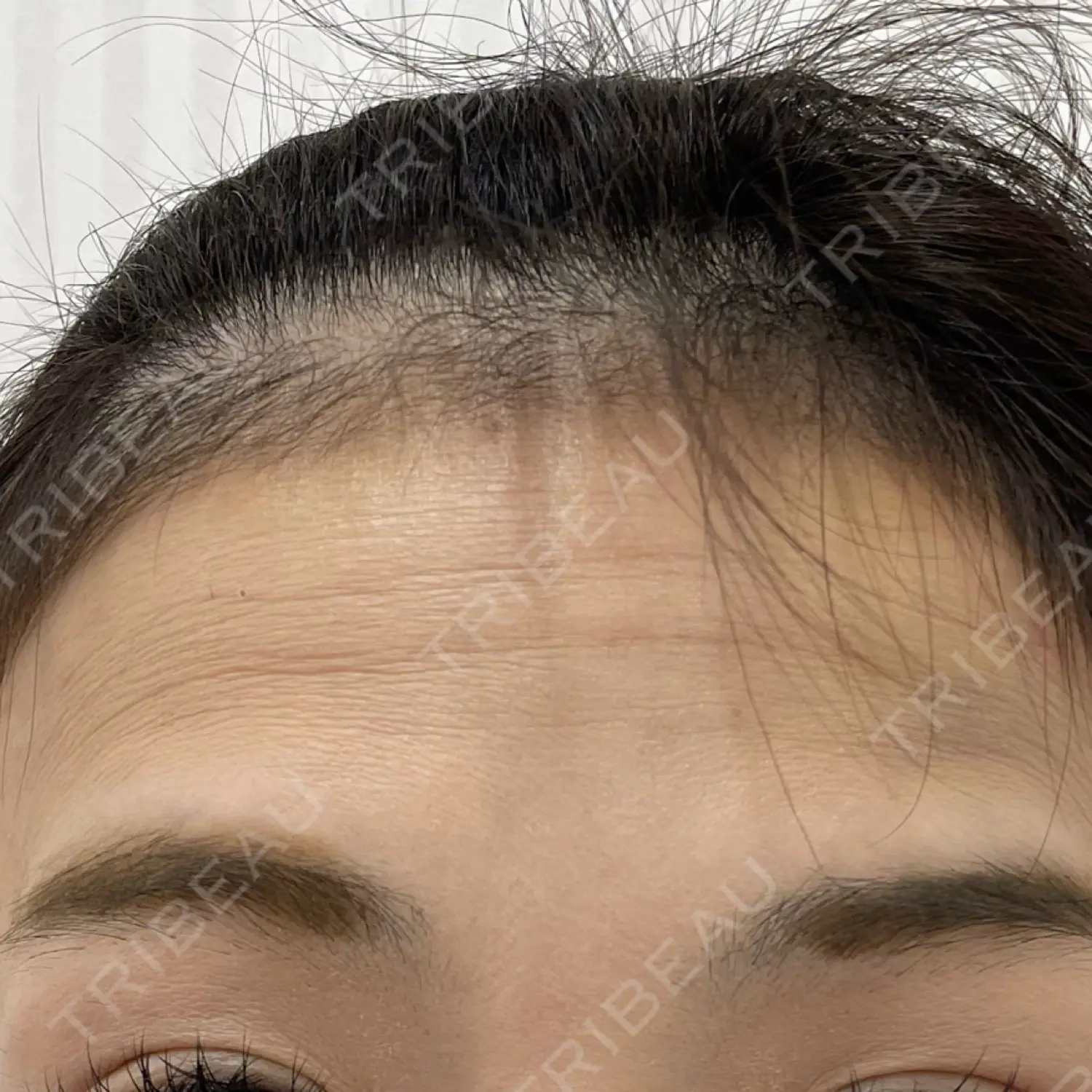 施術前の写真