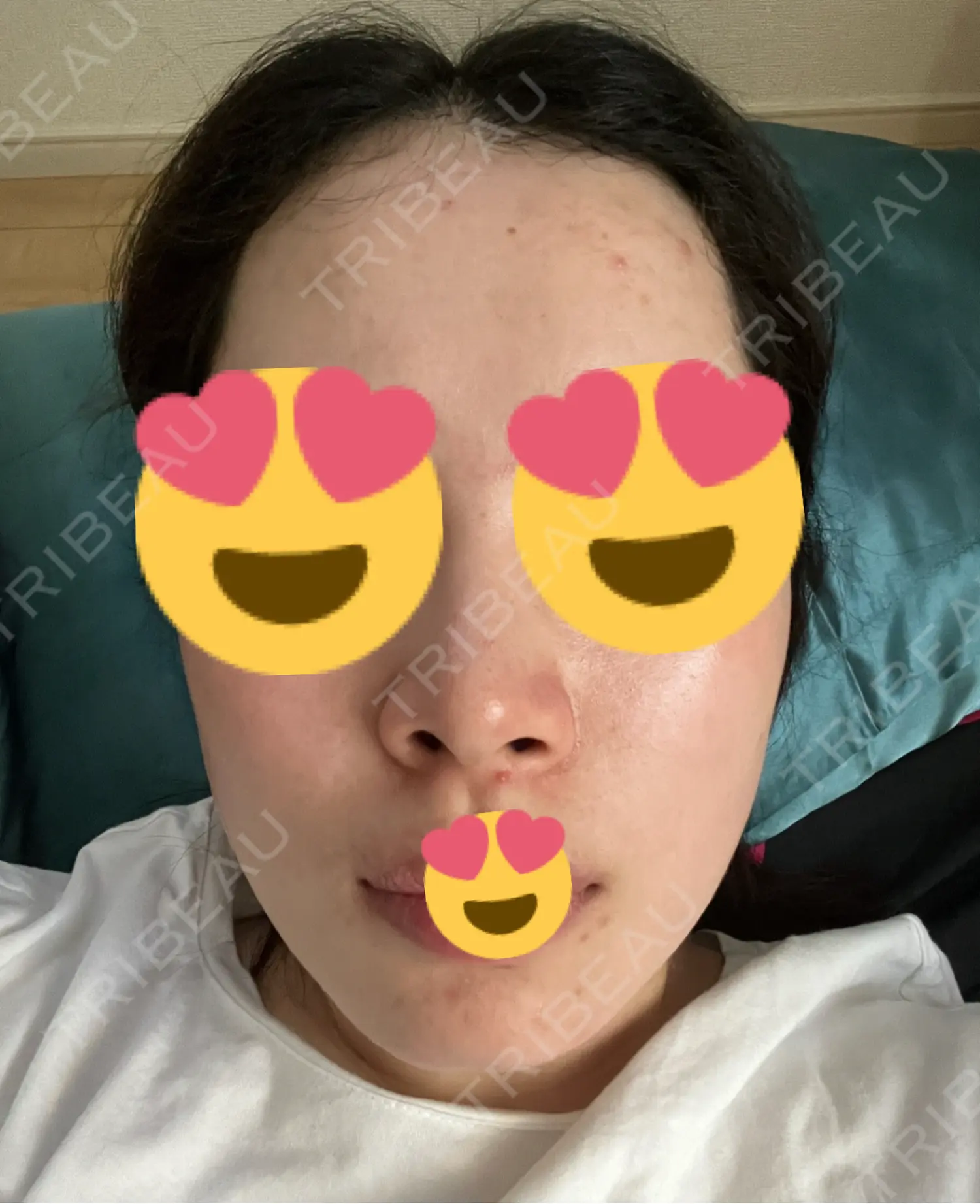 施術前の写真