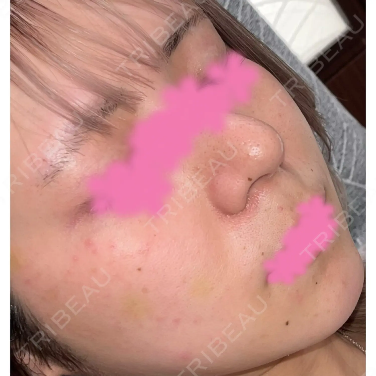 施術前の写真