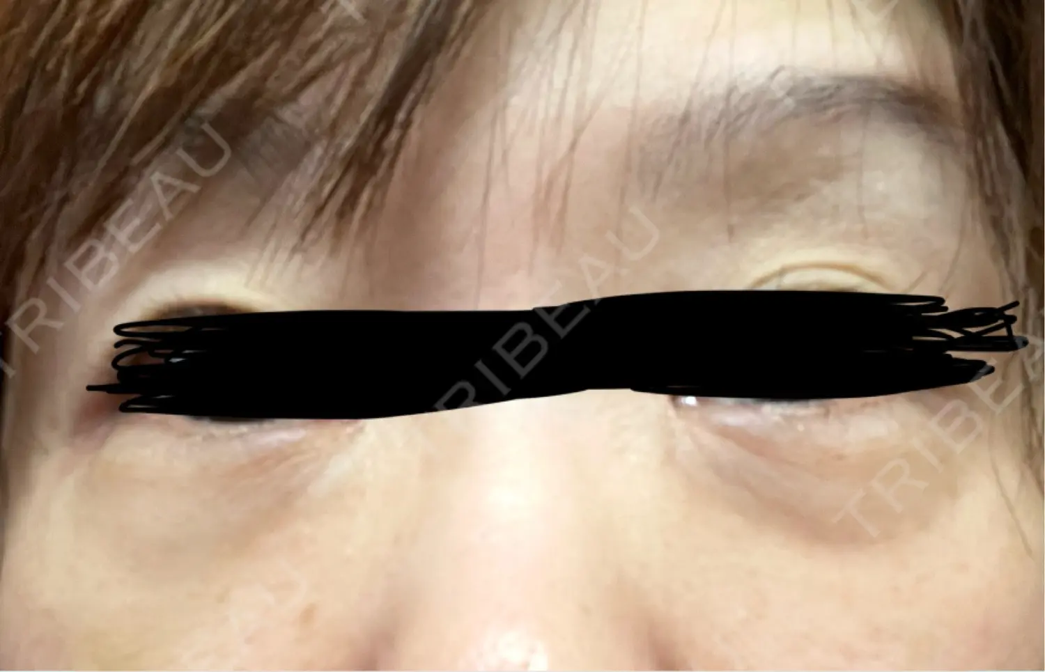 施術前の写真