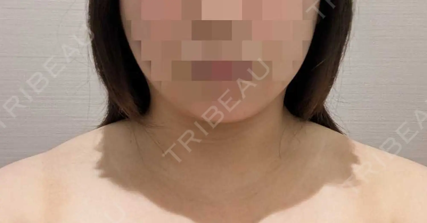 施術前の写真