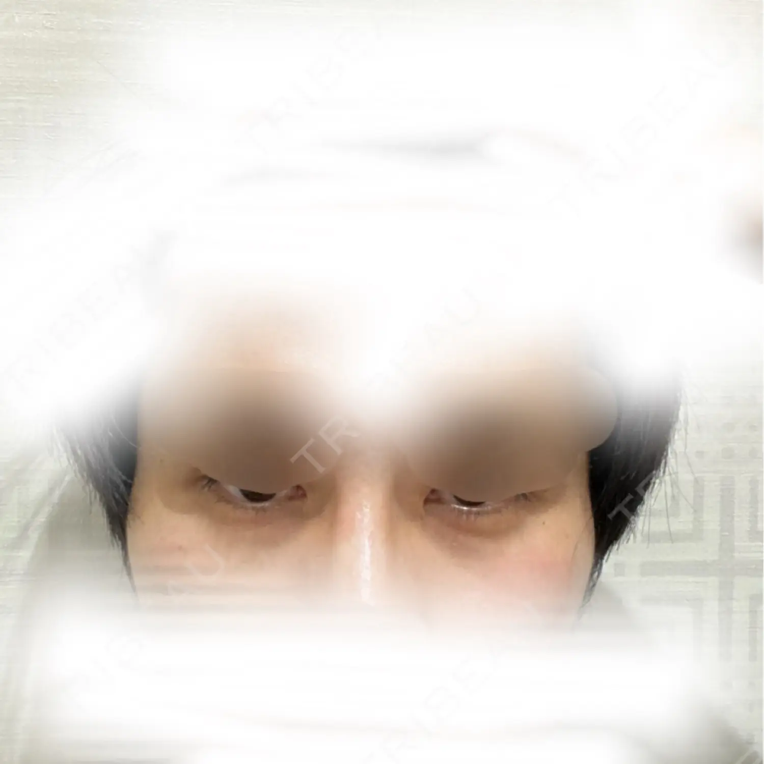 施術前の写真