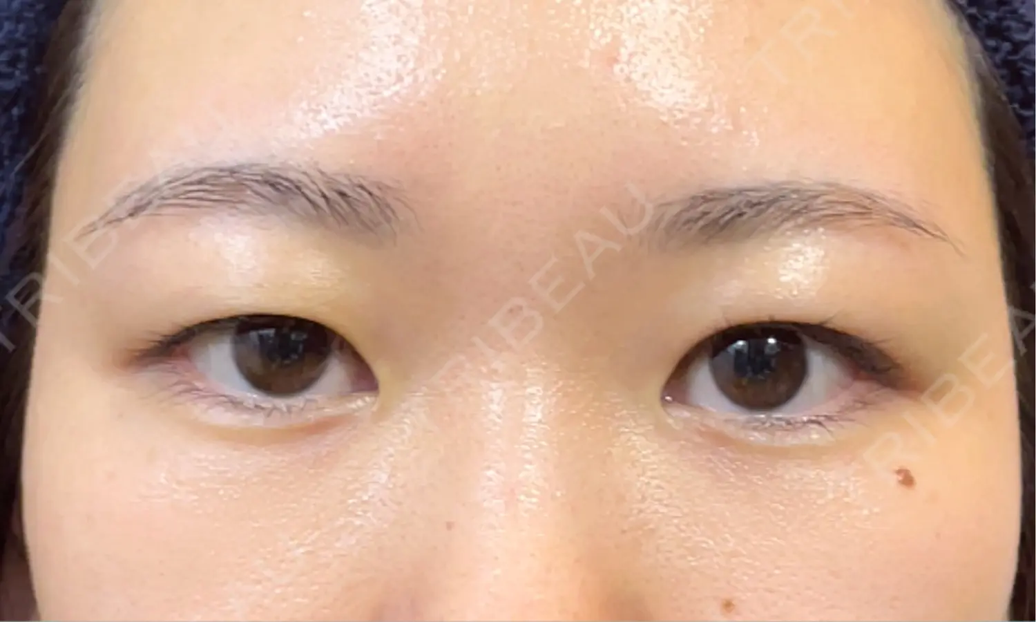 施術前の写真