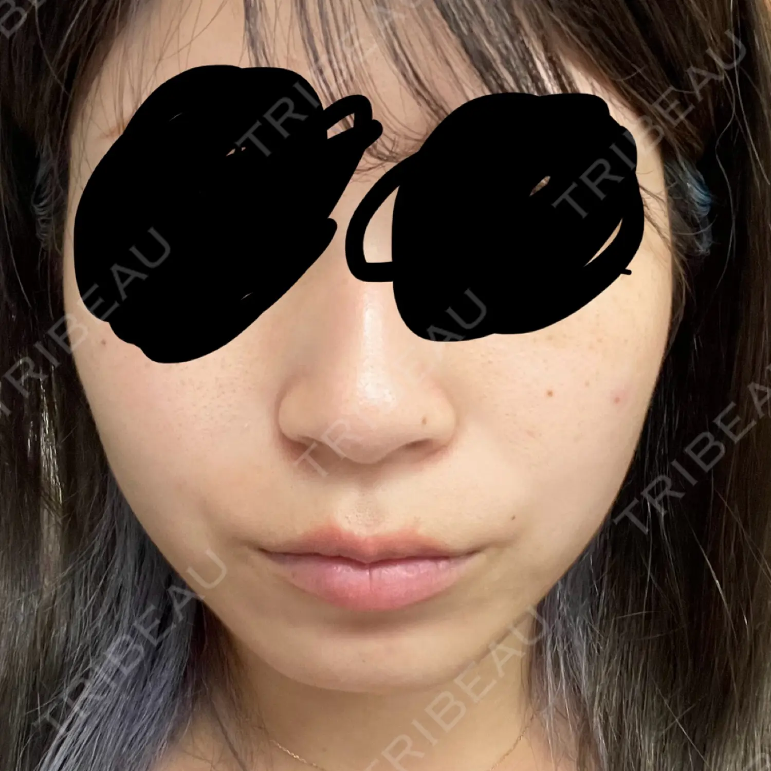 施術前の写真