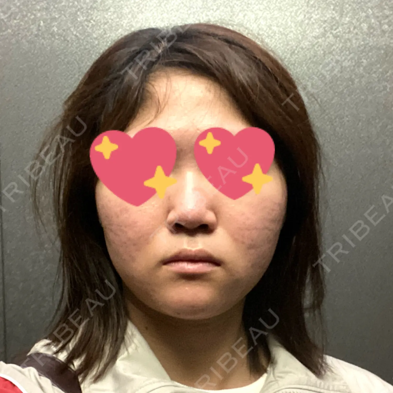 施術前の写真