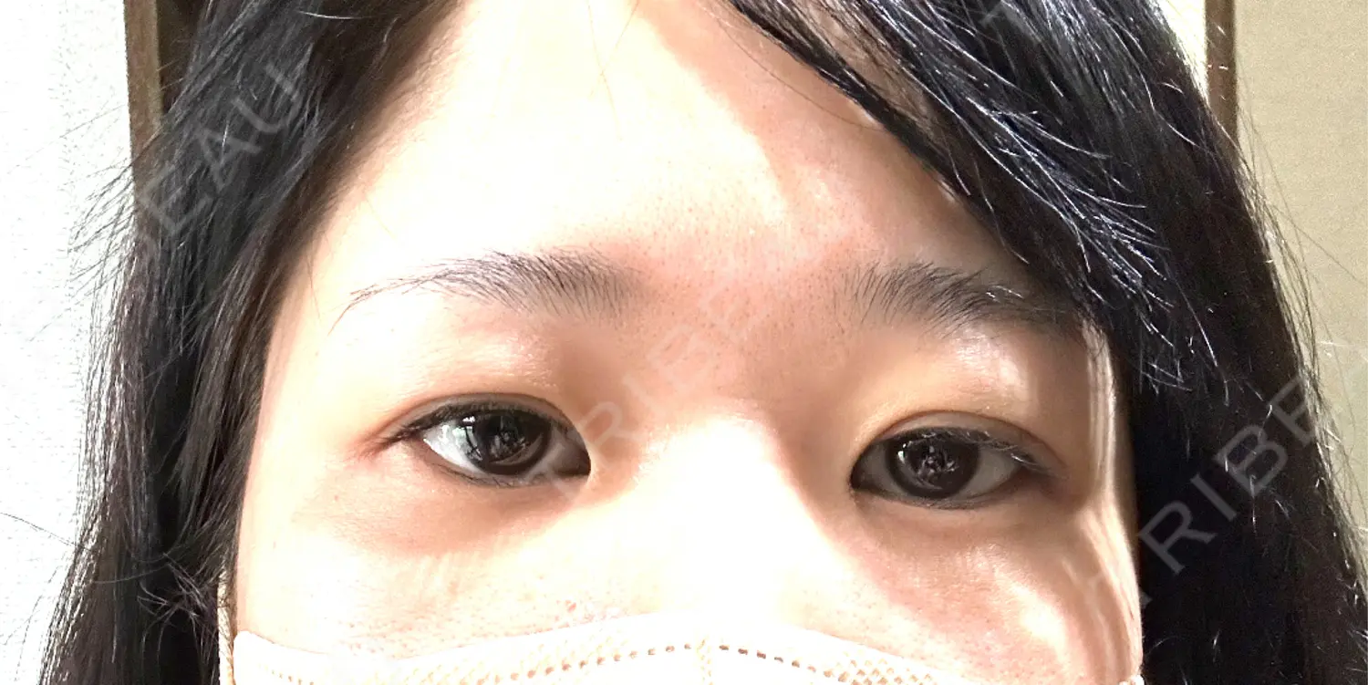 施術前の写真