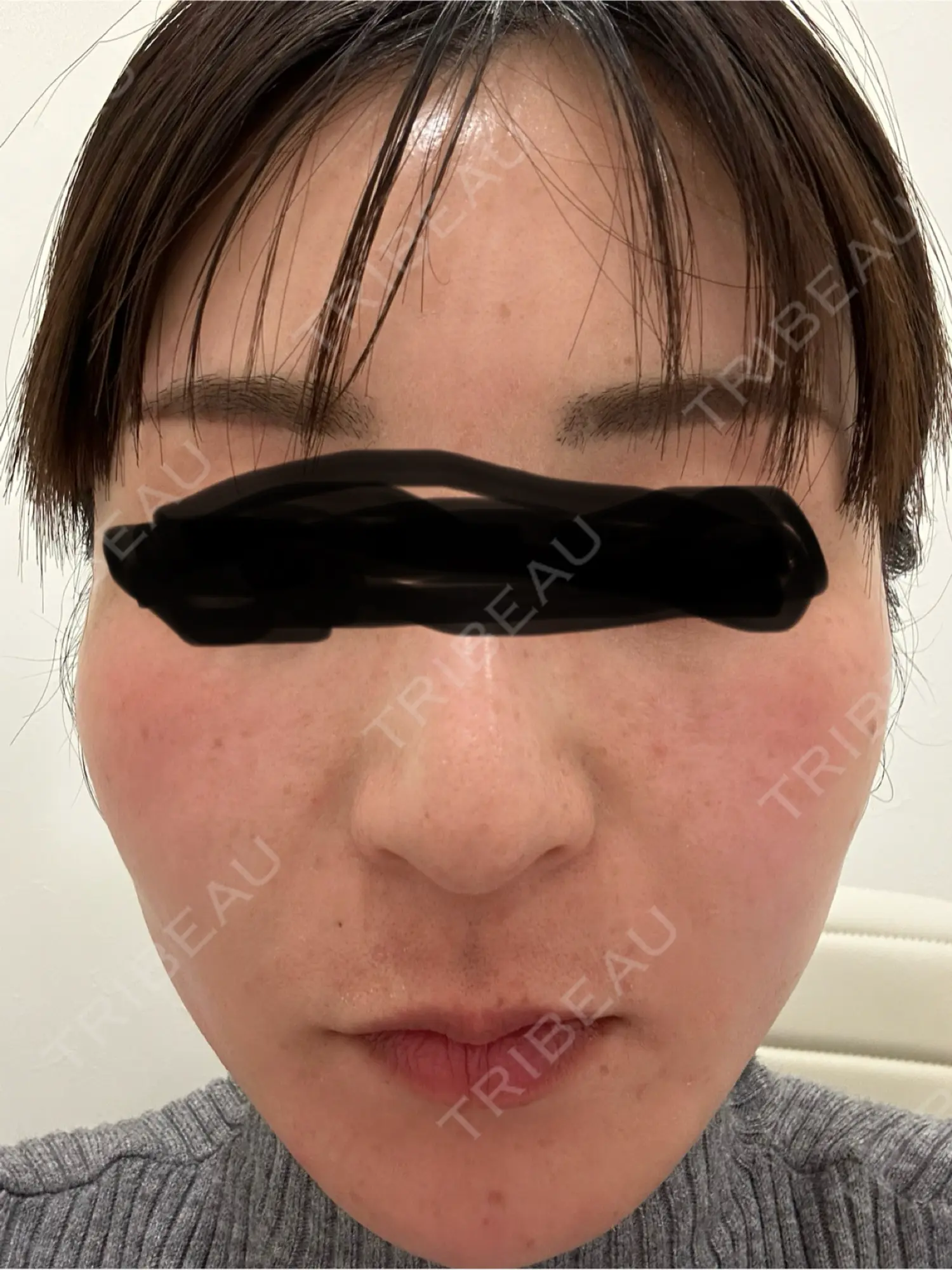 施術前の写真