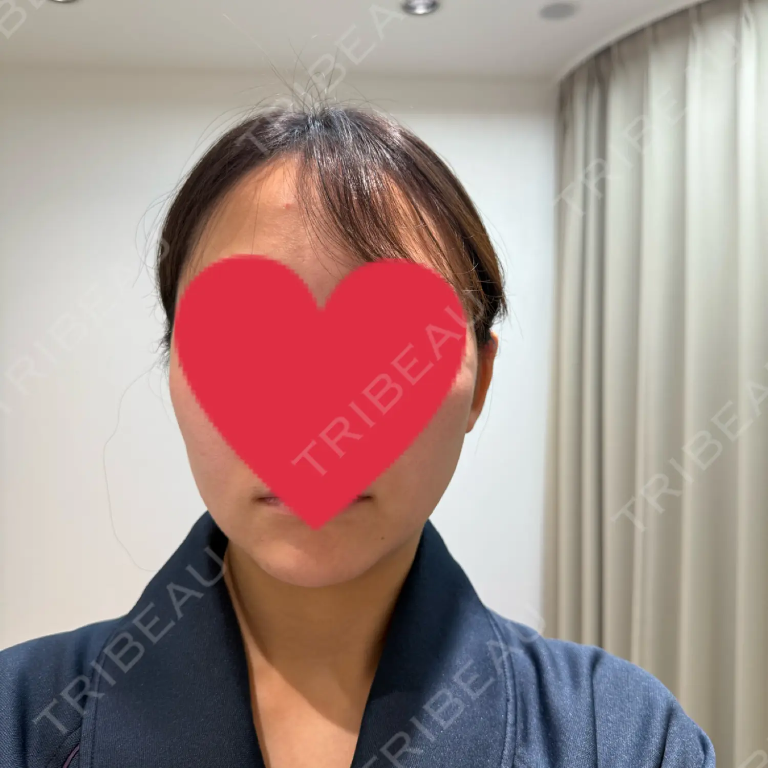 施術前の写真
