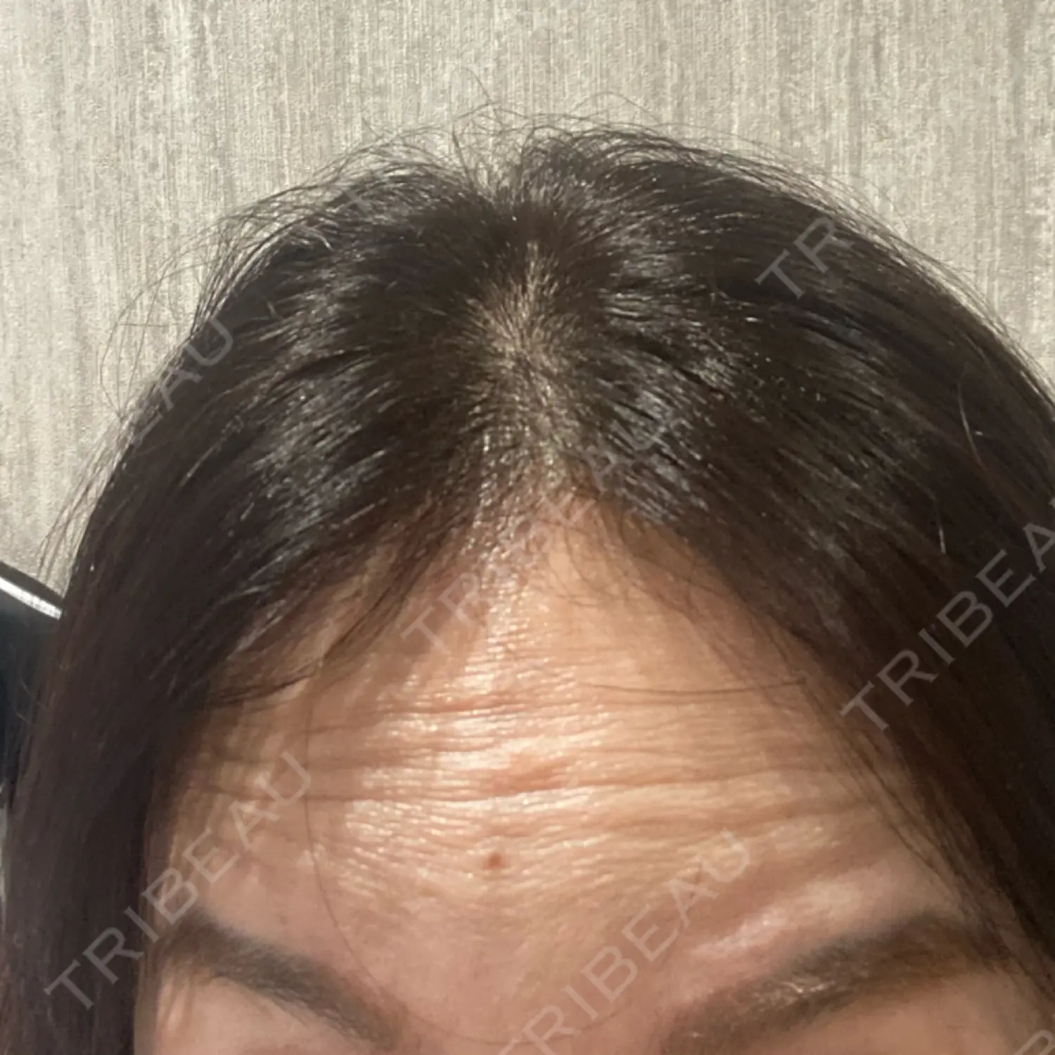 施術前の写真
