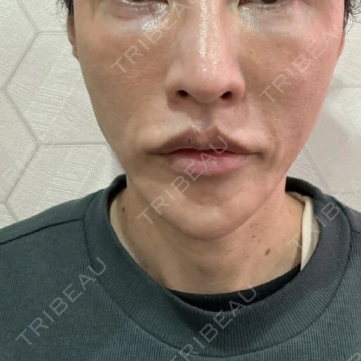 施術前の写真