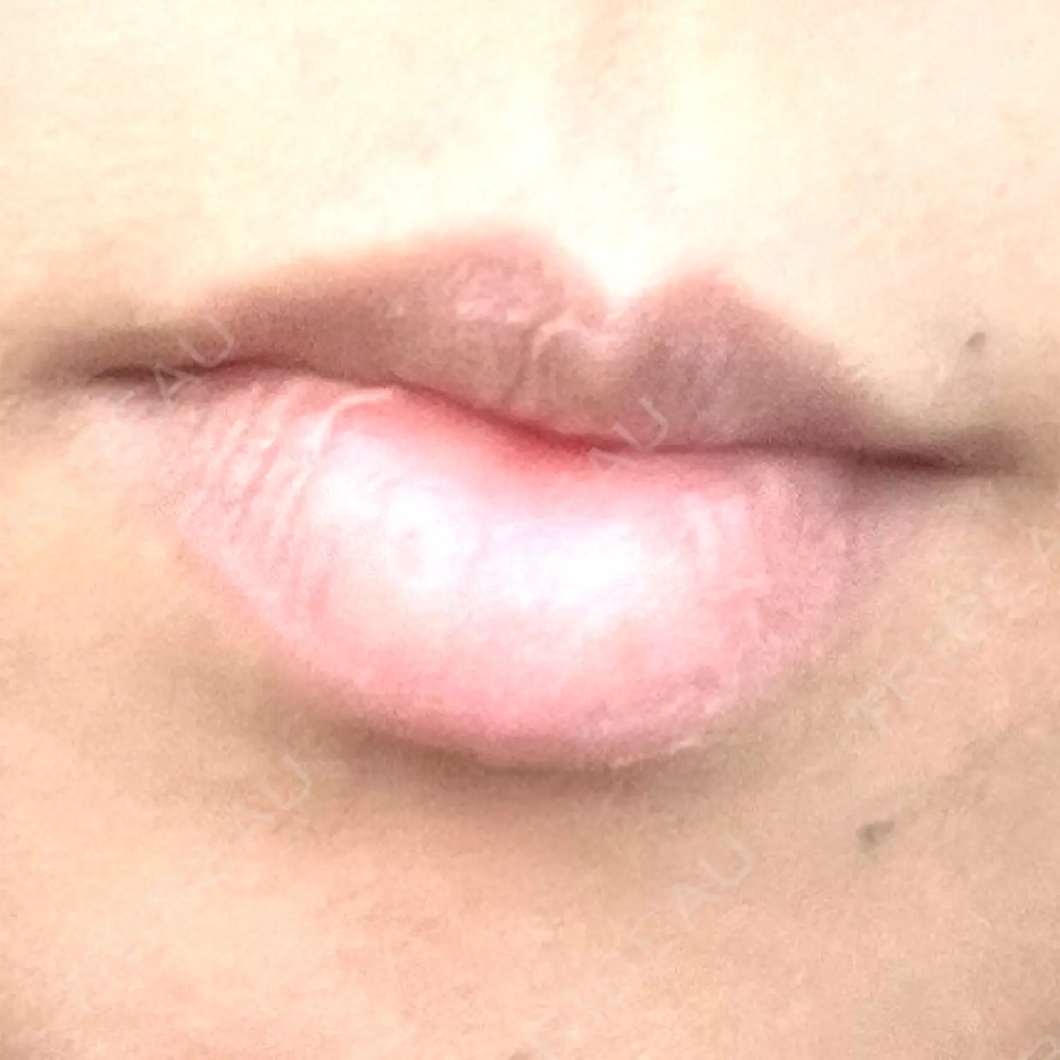 施術前の写真