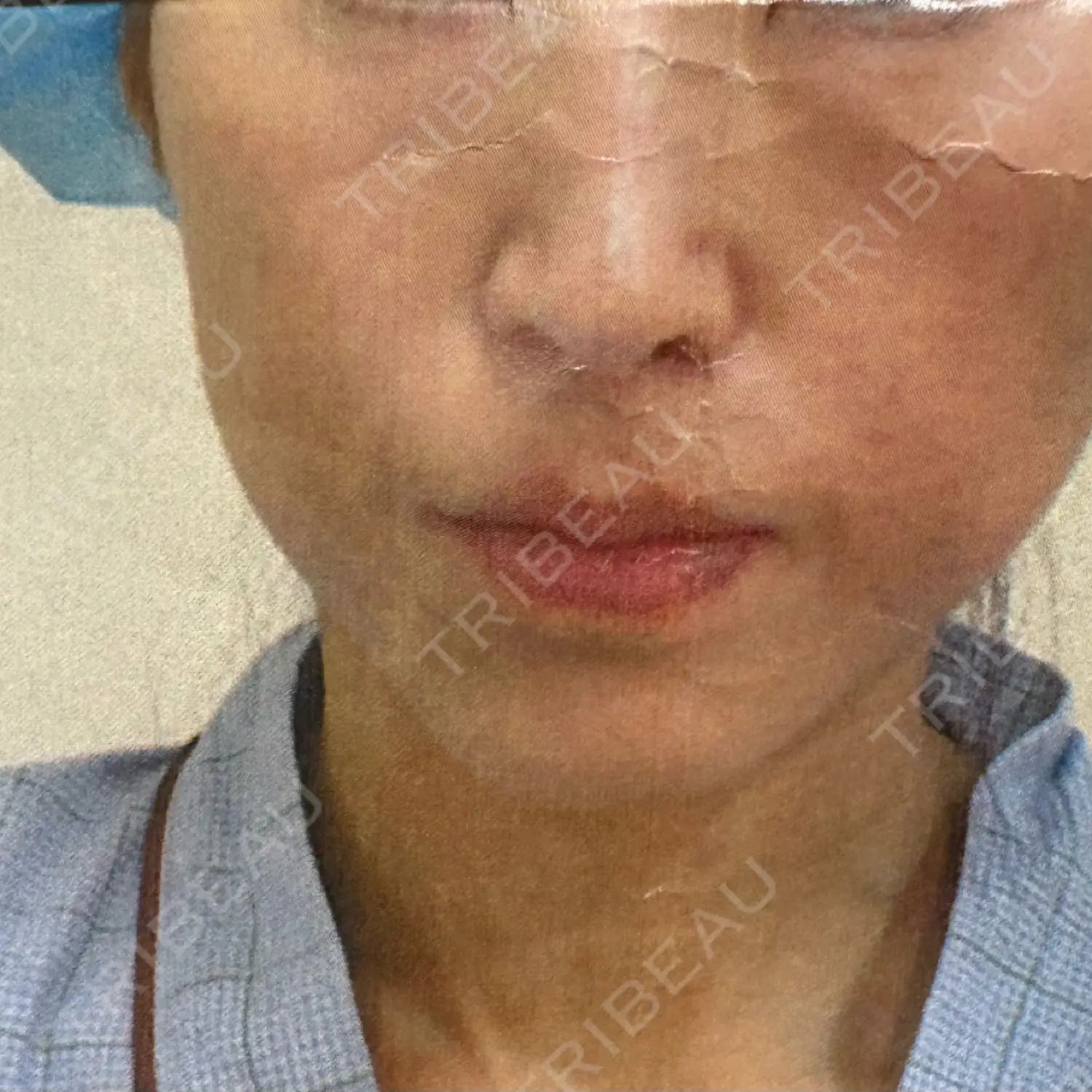 施術前の写真