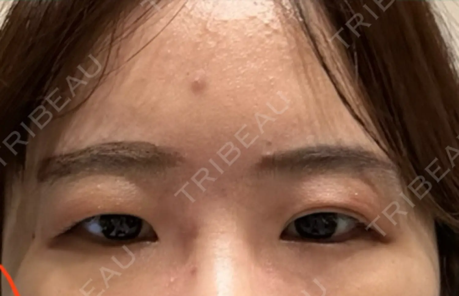 施術前の写真
