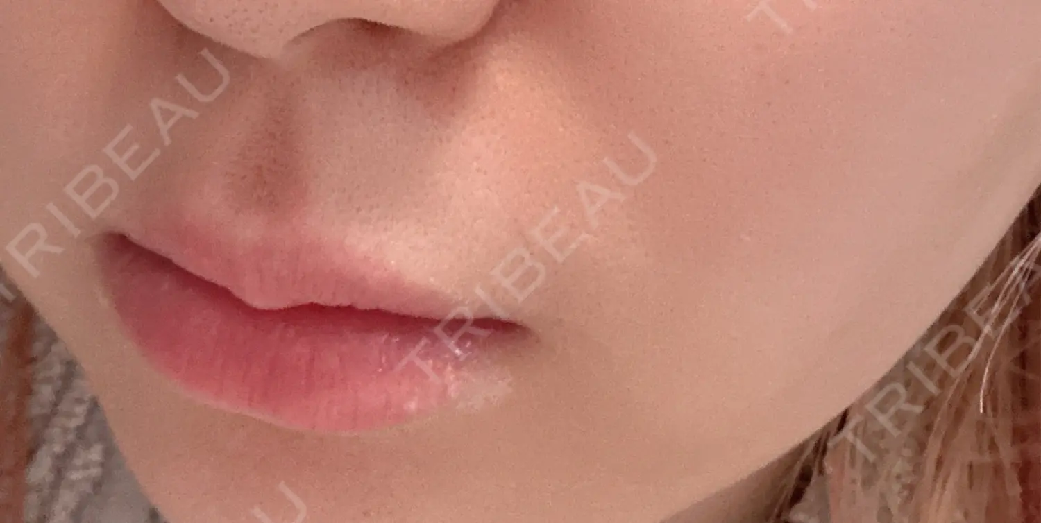 施術前の写真