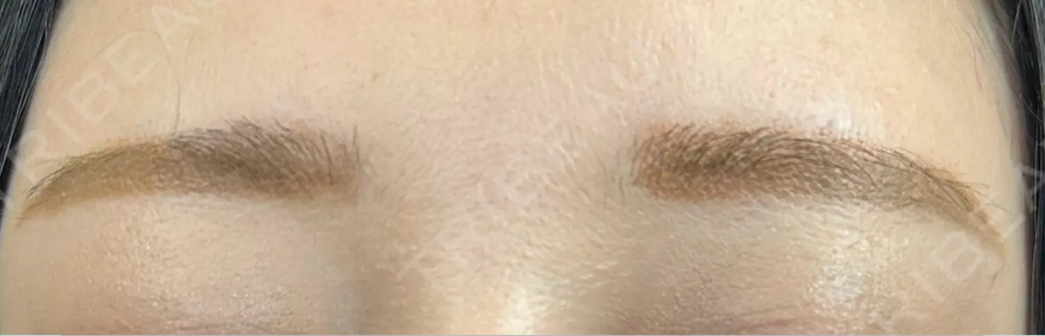 施術前の写真