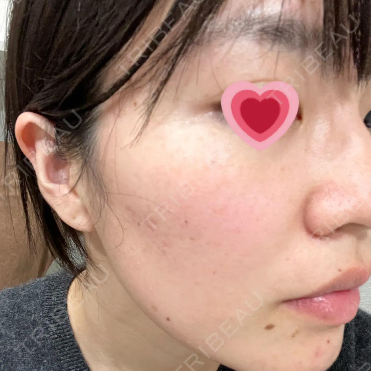施術前の写真