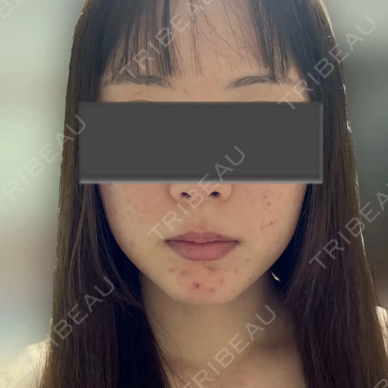 施術前の写真