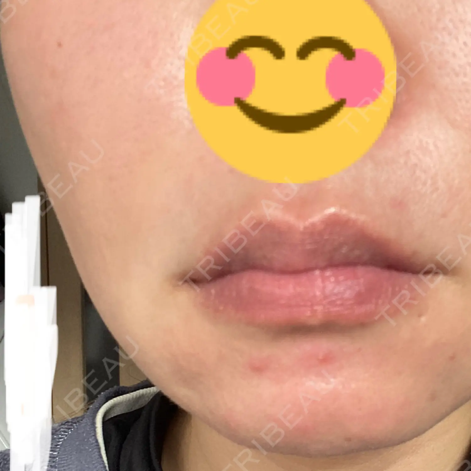 施術前の写真