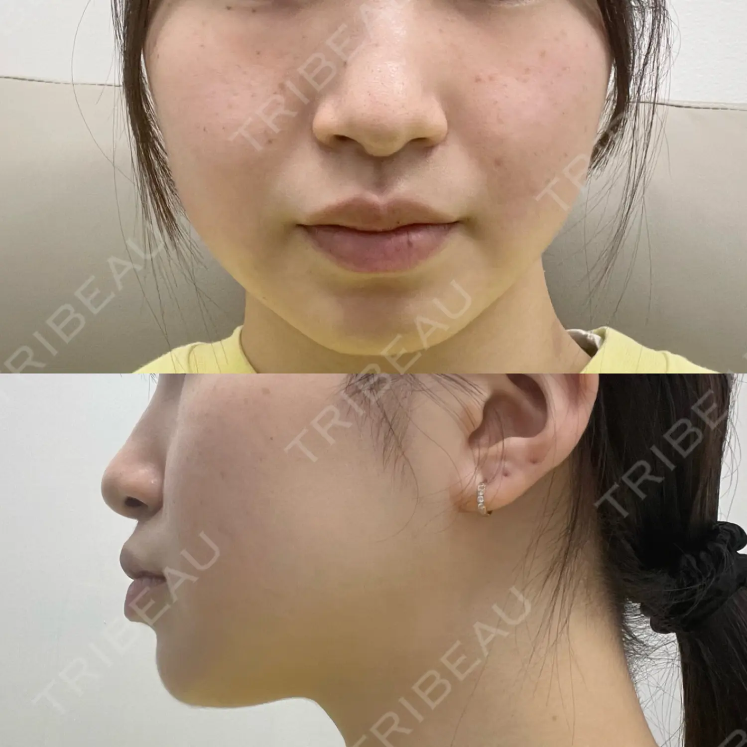 施術前の写真