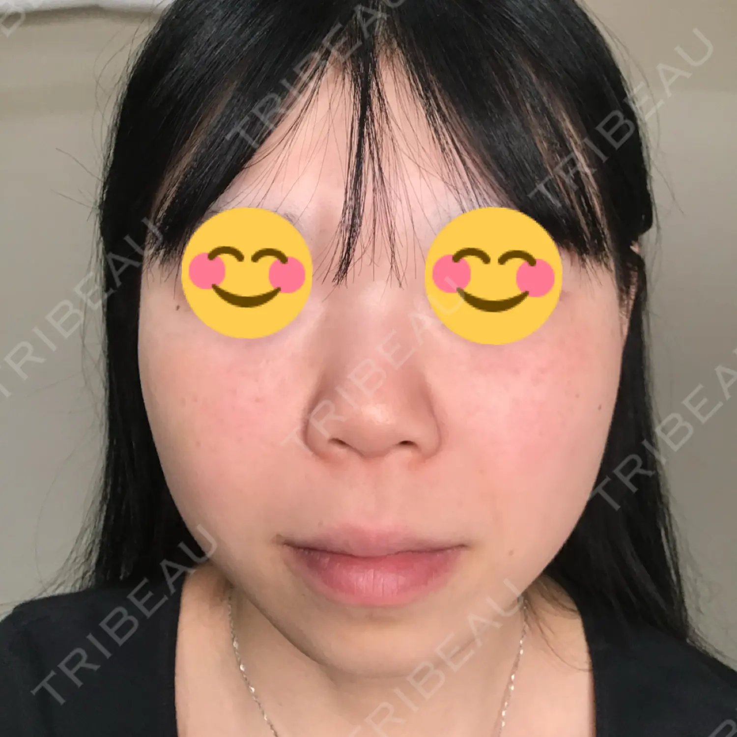 施術前の写真