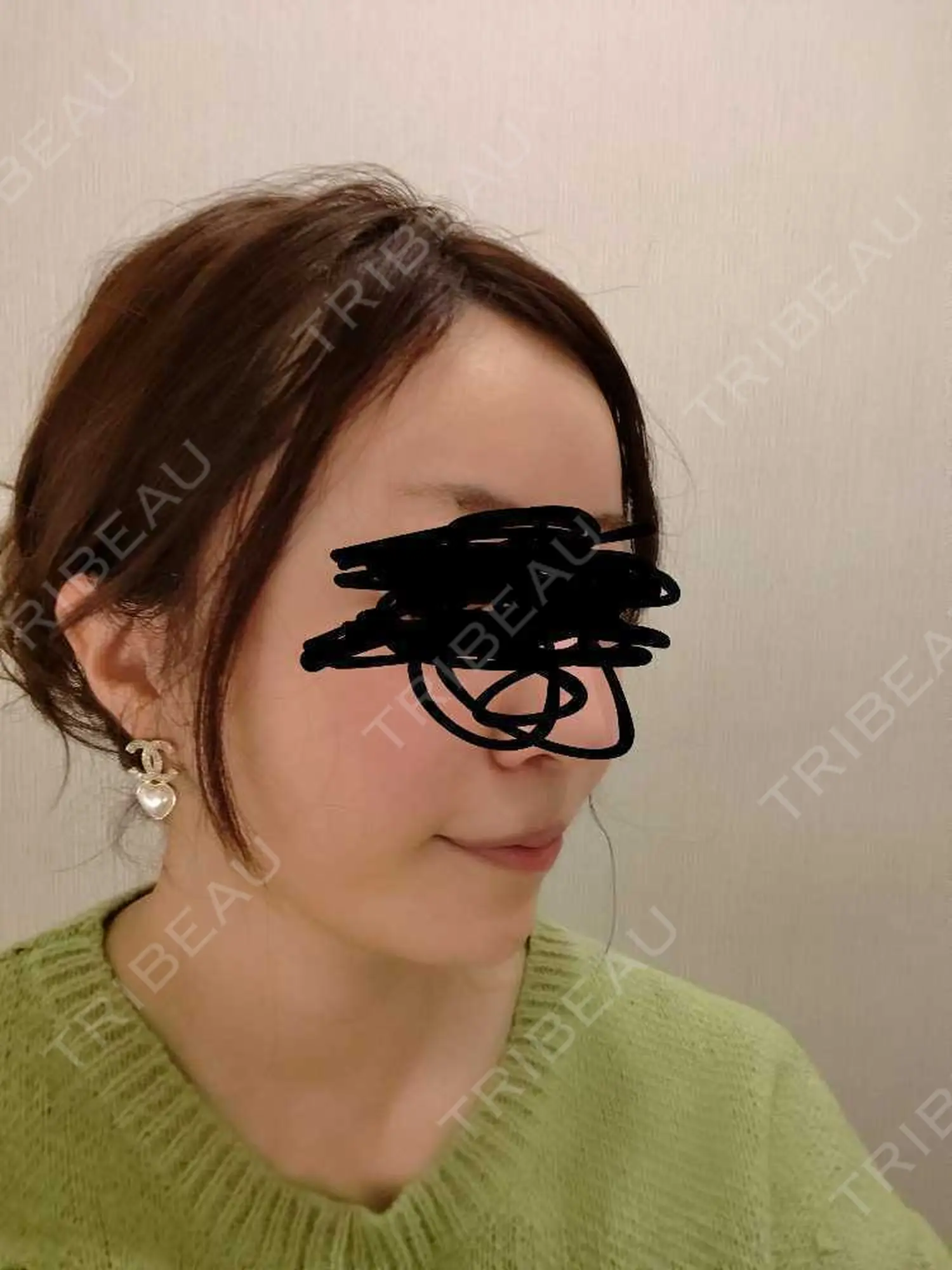 施術前の写真