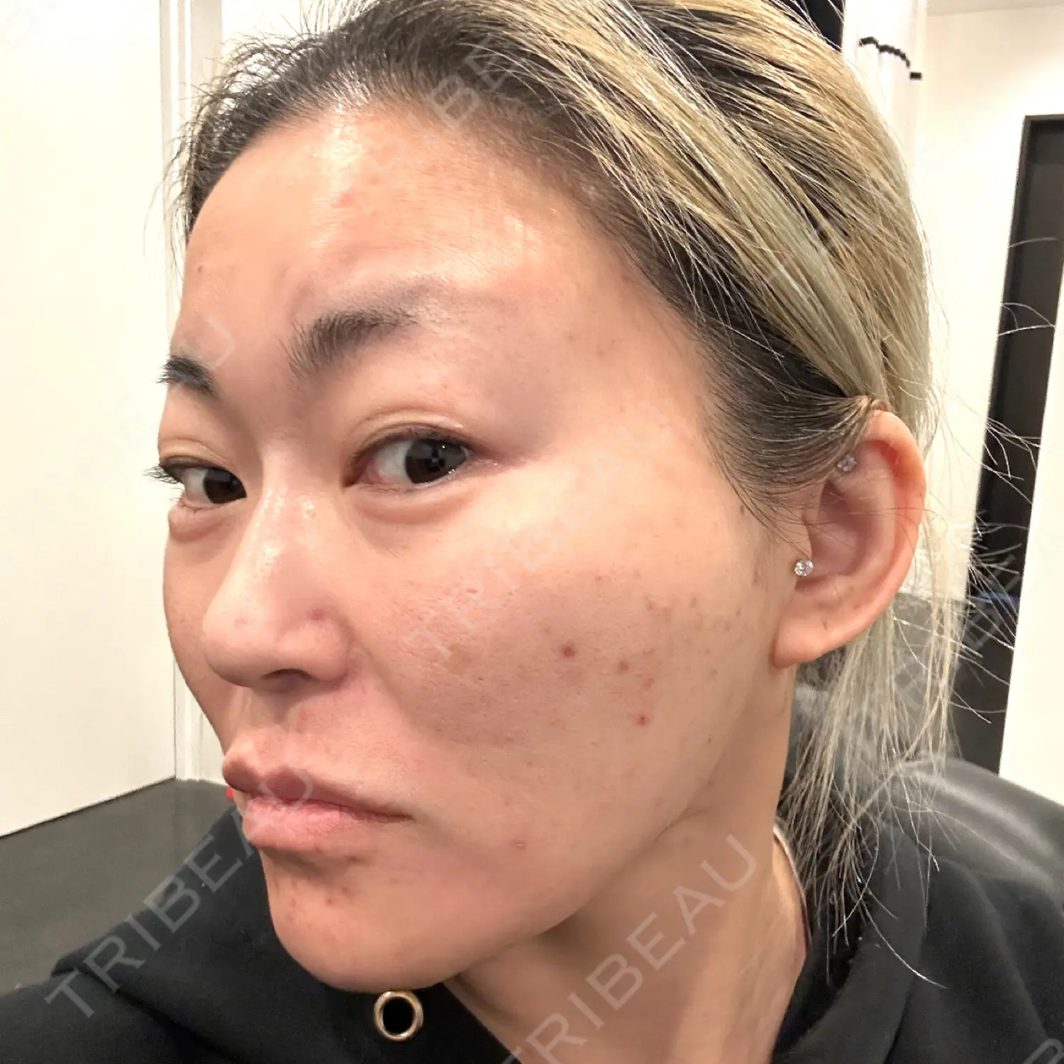 施術前の写真