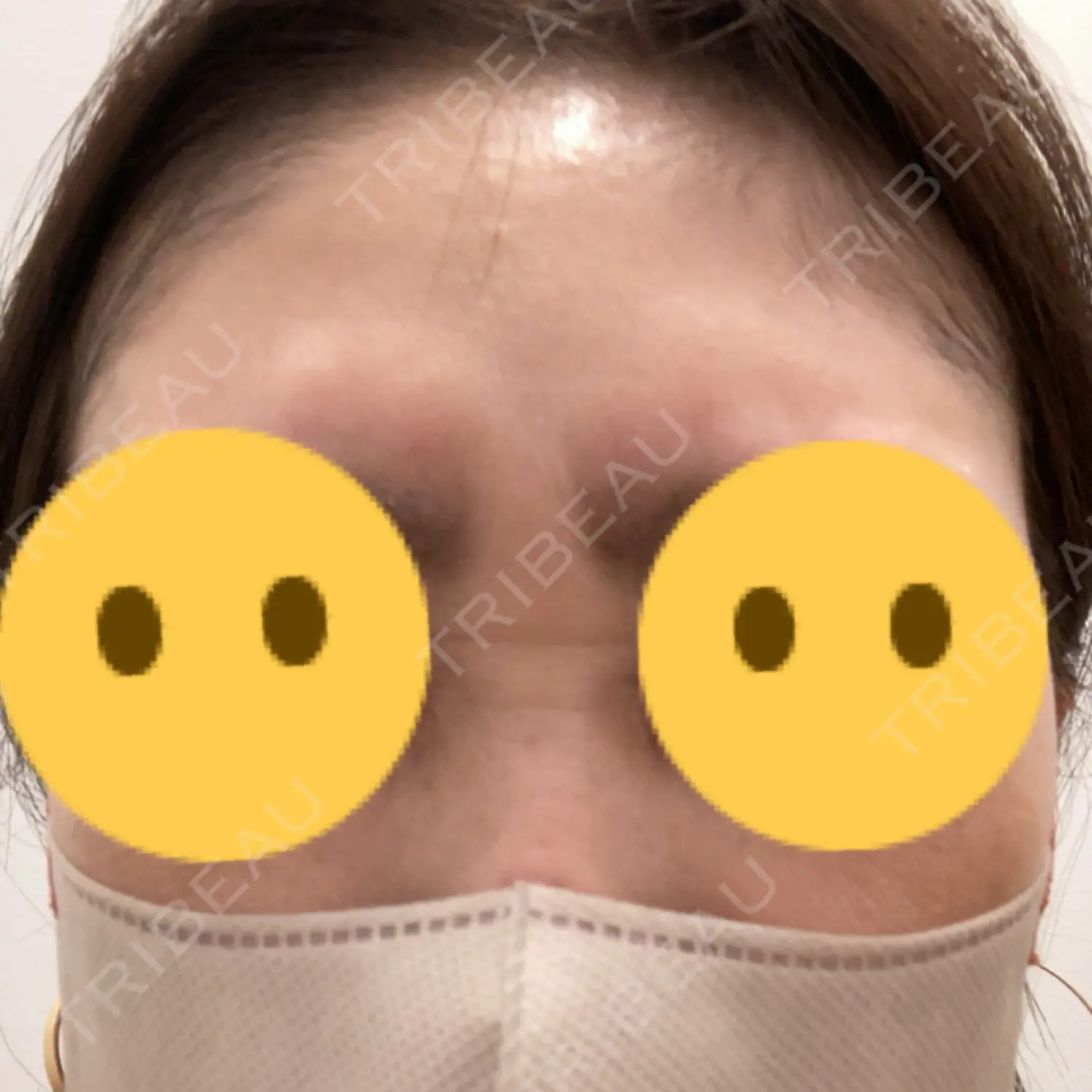 施術前の写真