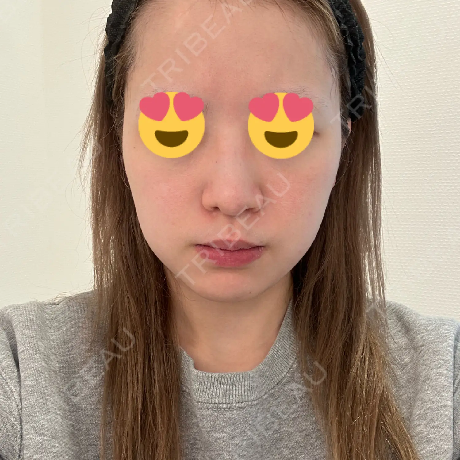 施術前の写真