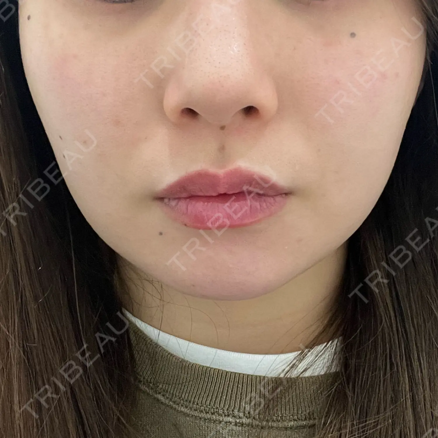 施術前の写真