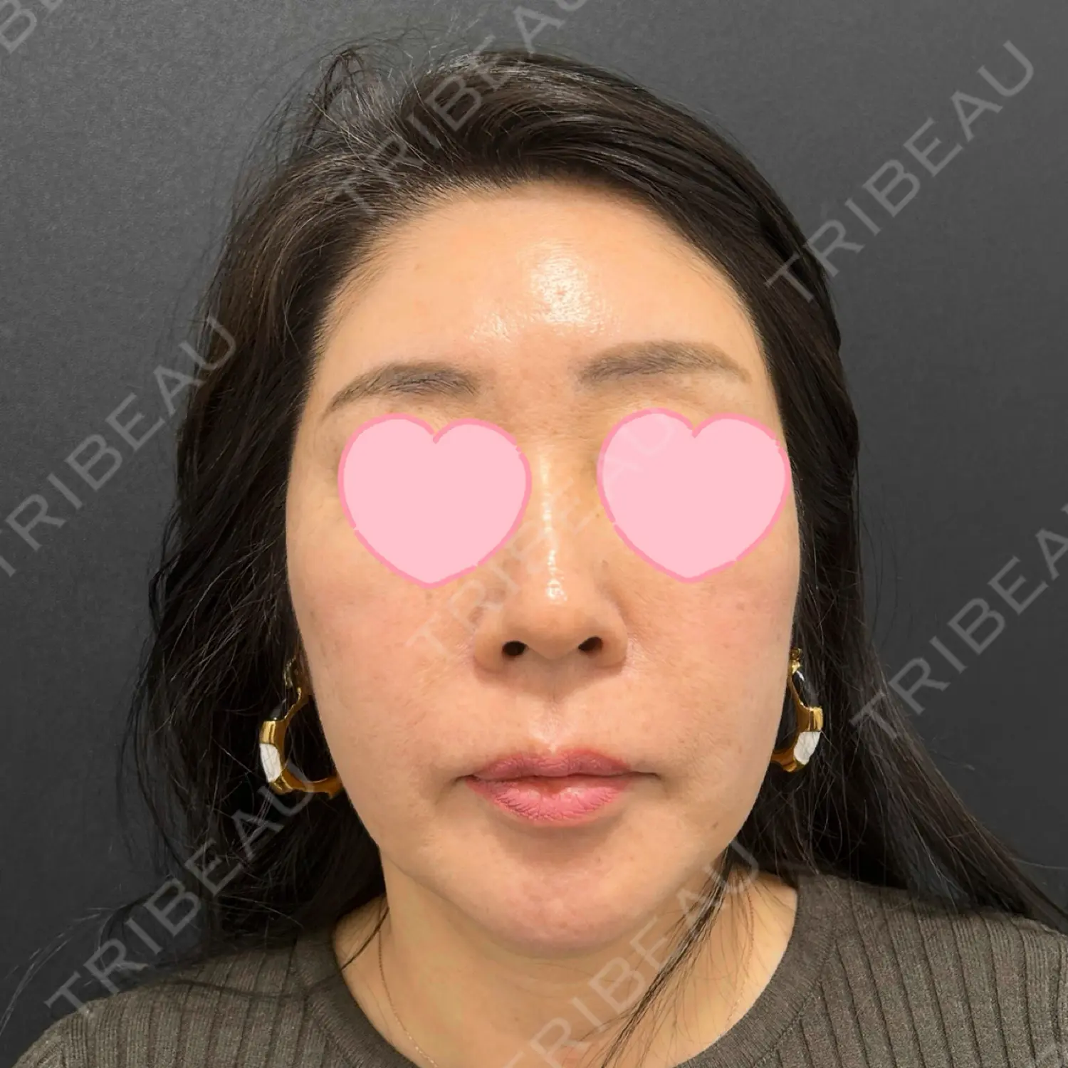 施術前の写真