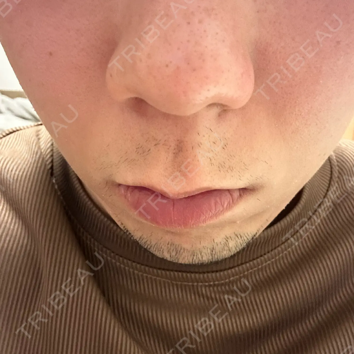 施術前の写真