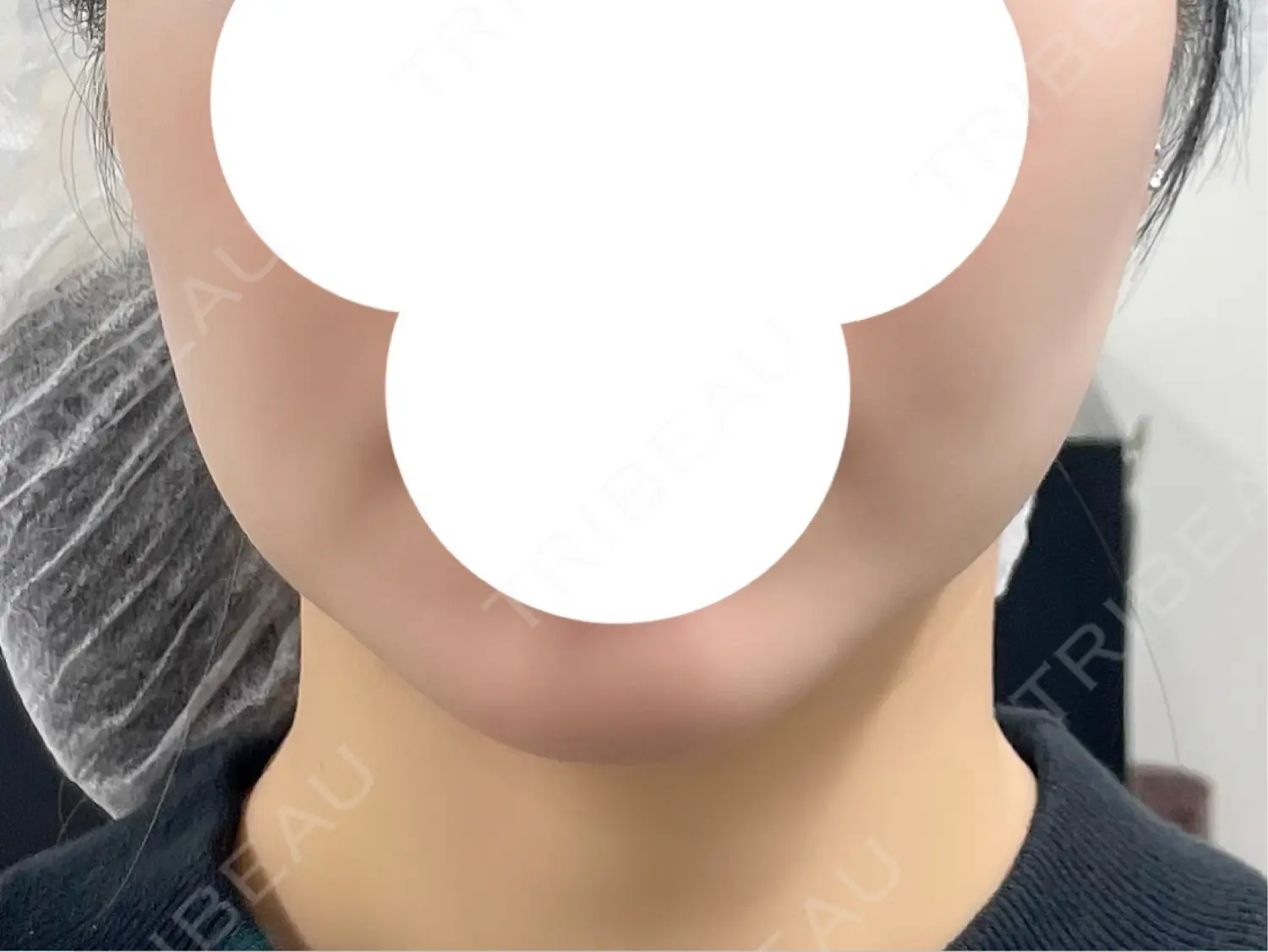 施術前の写真